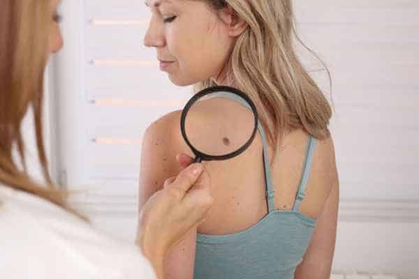 What Are Traditional Skin Lesion Removal Methods Acton?