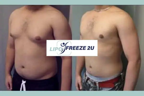 How Long Does It Take to See Results Acton?