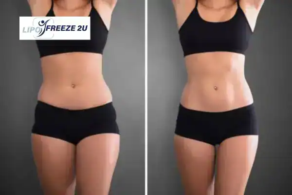 How Can LIPO FREEZE 2U Support Your Post-Pregnancy Body Recovery Acton?