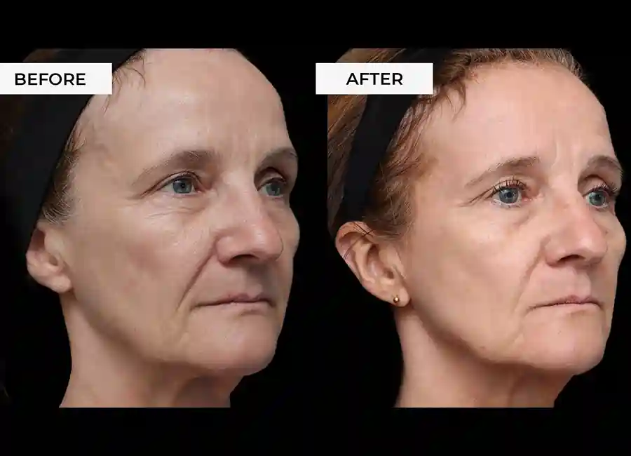 How Many RF Microneedling Sessions Will You Need to See a Difference Acton?