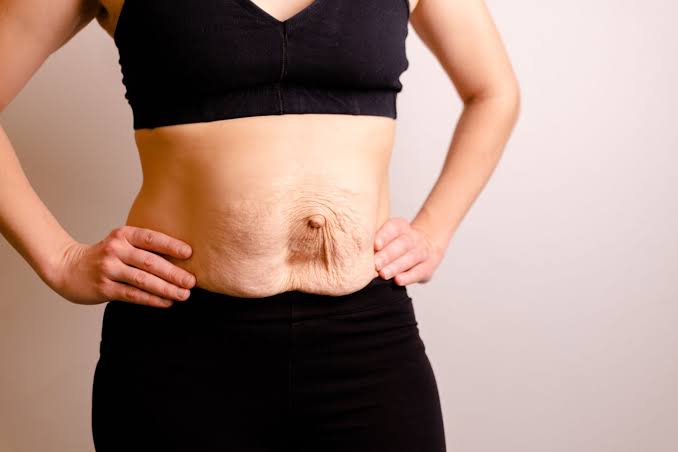 Is Surgery Really the Only Way to Repair Diastasis Recti Acton?