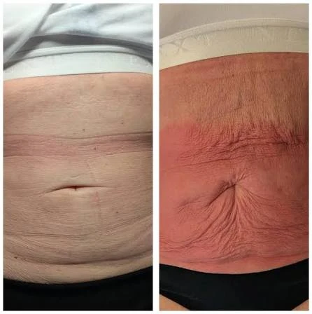 How Does RF Microneedling Improve Crepey, Thin and Uneven Skin Texture Acton?