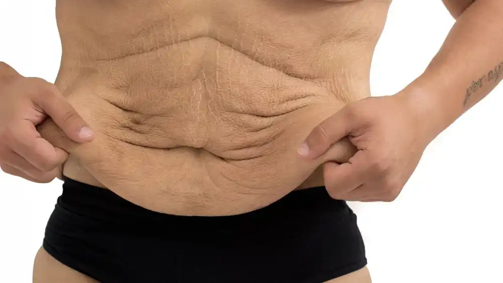 RF Microneedling for Loose Skin: How Can It Help Tighten and Reshape the Skin Acton?